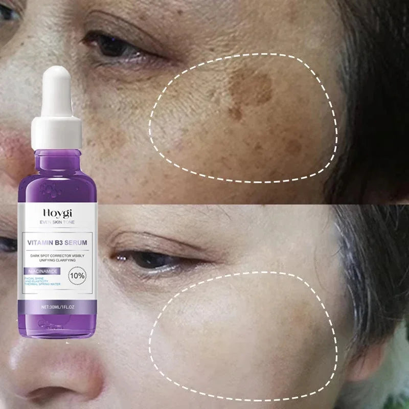 Powerful Dark Spots Remover Whitening Serum Face Freckle Melanin Correcting Anti Pigmentation Brighten Skin Beauty Care Essence